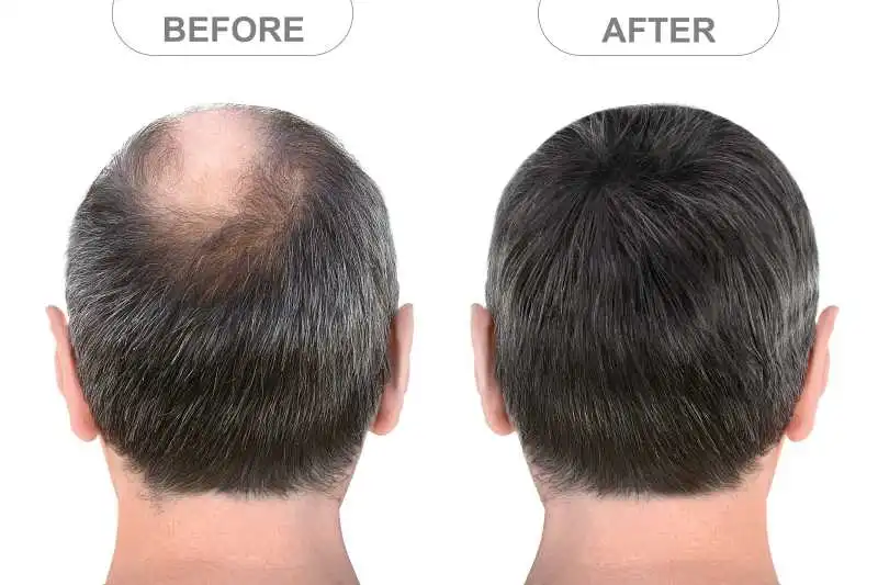 Non-Surgical Hair Restoration Service in Hyderabad
